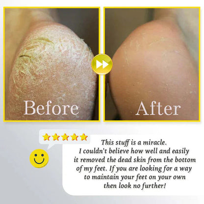 Uppladdningsbar Elektrisk Fotfil för Förhårdnader